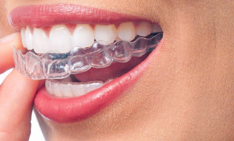 Invisalign- Clear aligners