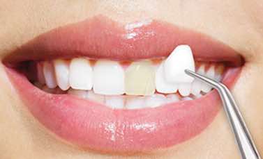 Cosmetic Dentistry-Dental Venners